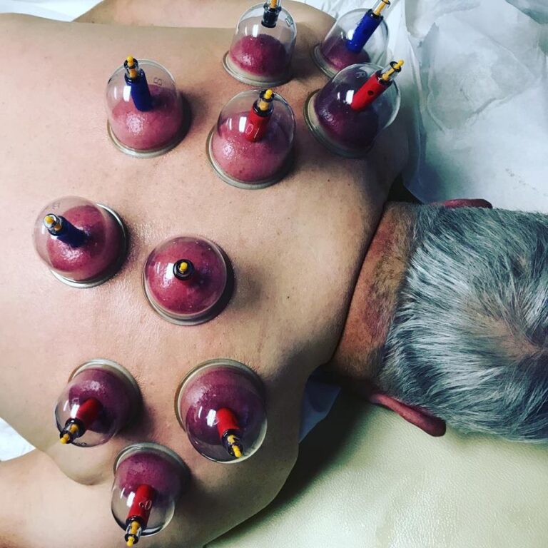 cupping2 768x768