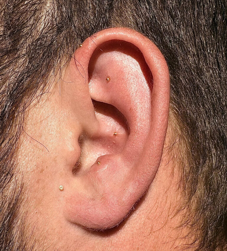 Ear Acupuncture in San Diego 768x849
